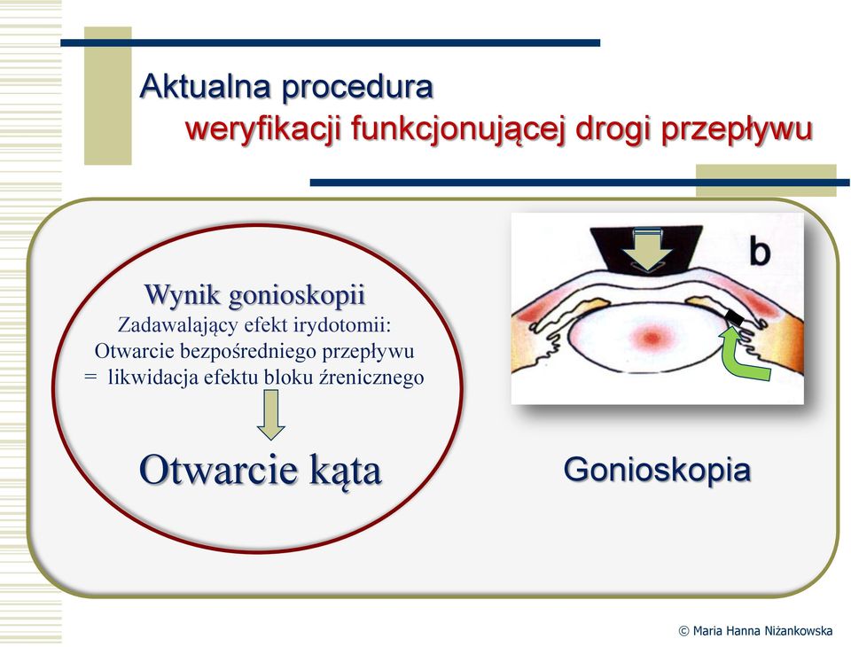 irydotomii: Otwarcie bezpośredniego przepływu =