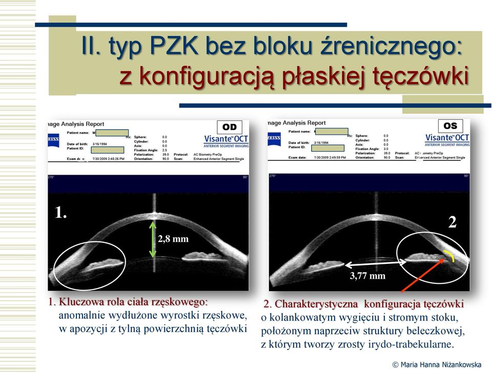 powierzchnią tęczówki 2.