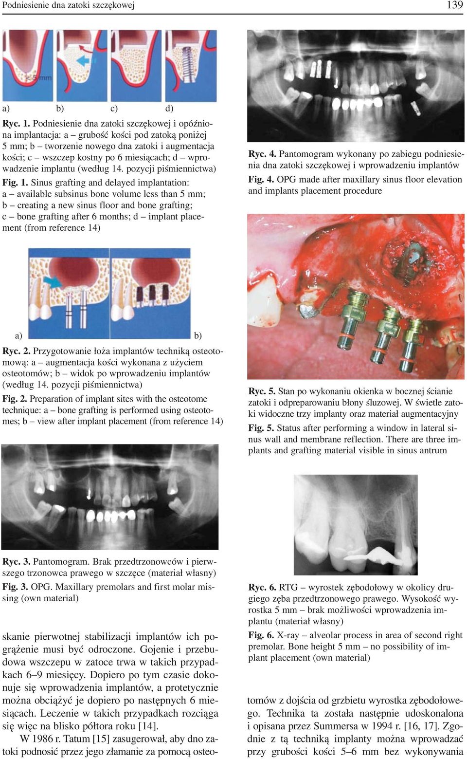 Podniesienie dna zatoki szczękowej i opóźnio na implantacja: a grubość kości pod zatoką poniżej 5 mm; b tworzenie nowego dna zatoki i augmentacja kości; c wszczep kostny po 6 miesiącach; d wpro