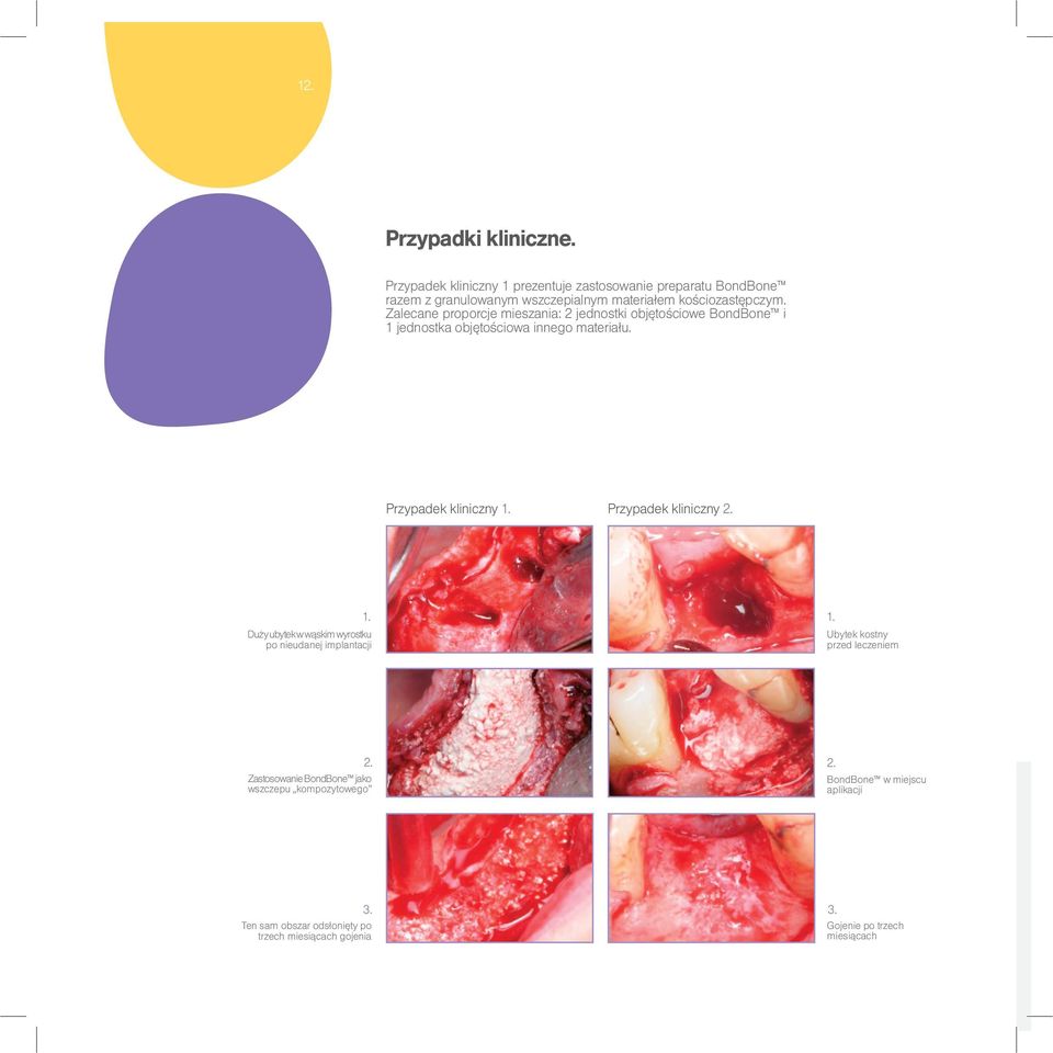 Zalecane proporcje mieszania: 2 jednostki objętościowe BondBone i 1 jednostka objętościowa innego materiału. Przypadek kliniczny 1.