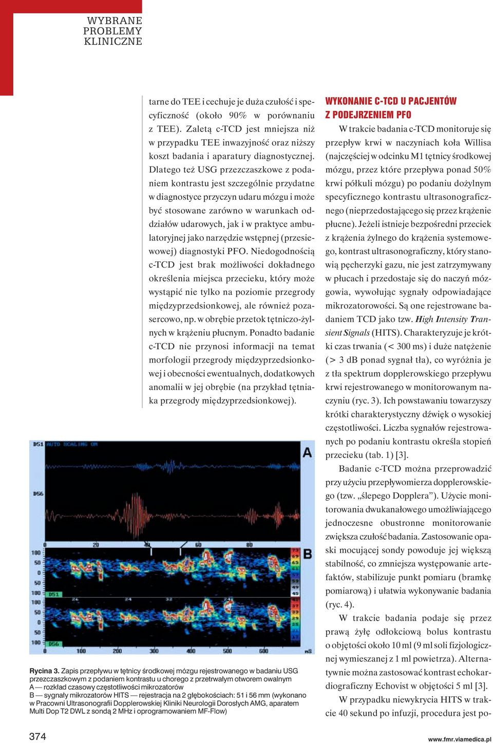 Dlatego też USG przezczaszkowe z podaniem kontrastu jest szczególnie przydatne w diagnostyce przyczyn udaru mózgu i może być stosowane zarówno w warunkach oddziałów udarowych, jak i w praktyce