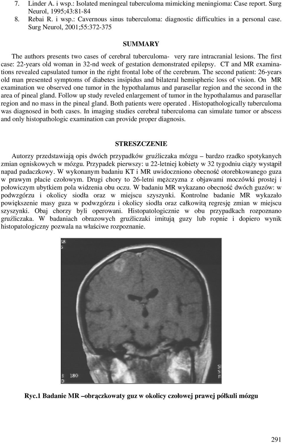 The first case: 22-years old woman in 32-nd week of gestation demonstrated epilepsy. CT and MR examinations revealed capsulated tumor in the right frontal lobe of the cerebrum.