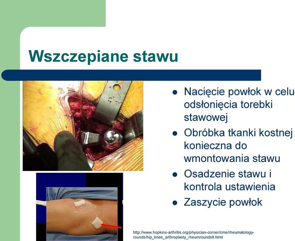 kontrola ustawienia Zaszycie powłok http://www.hopkins-arthritis.