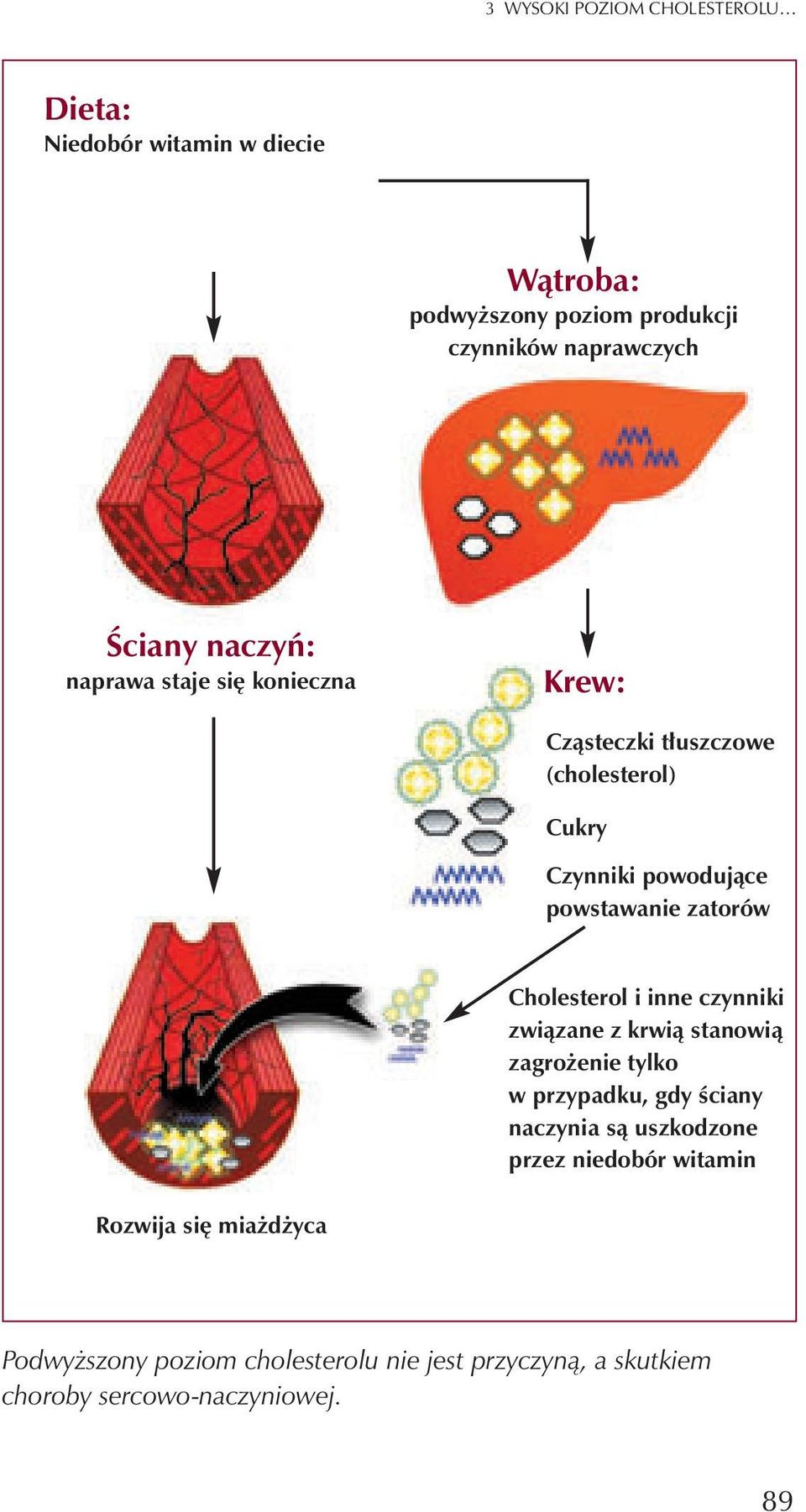 zatorów Cholesterol i inne czynniki zwi¹zane z krwi¹ stanowi¹ zagro enie tylko w przypadku, gdy œciany naczynia s¹ uszkodzone