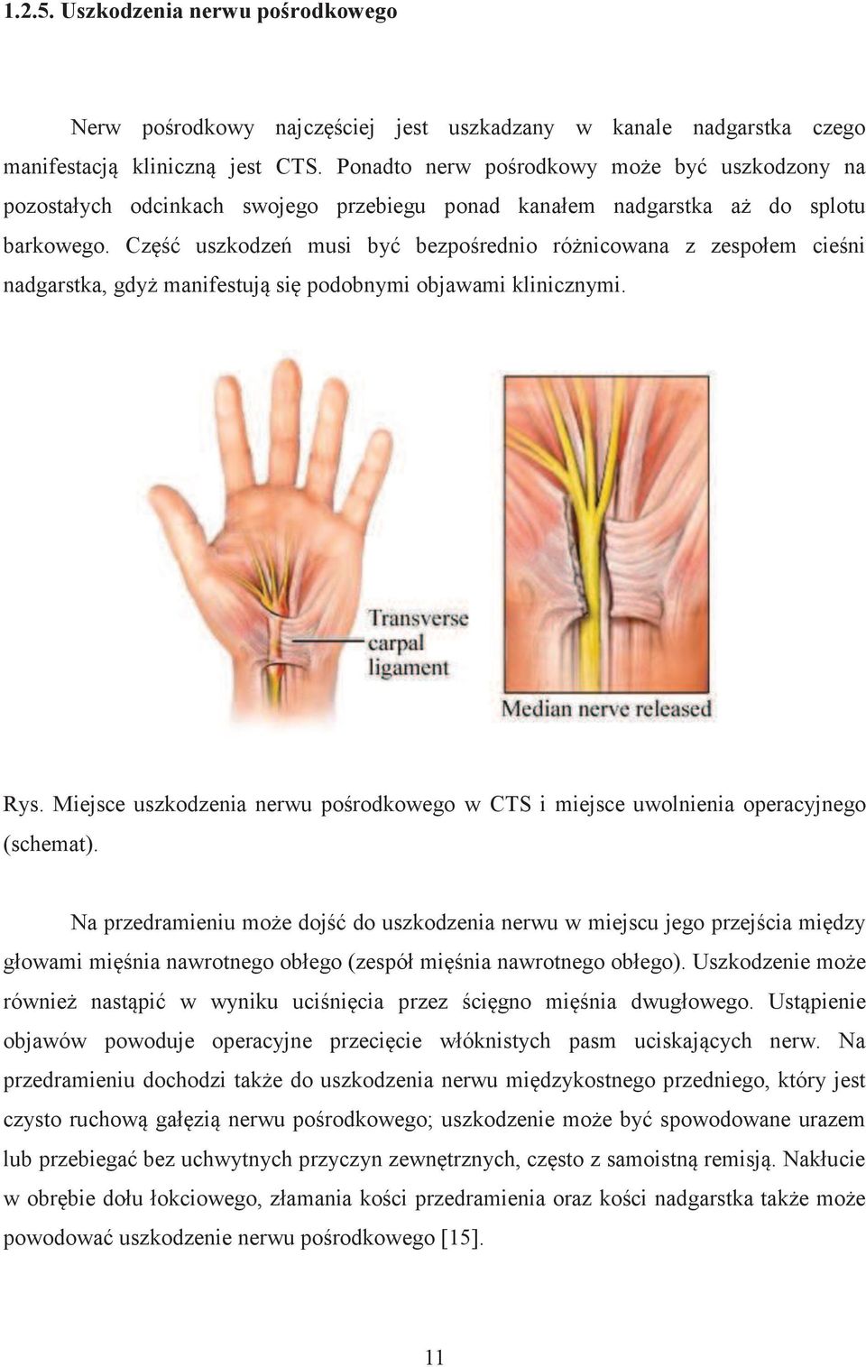 Część uszkodzeń musi być bezpośrednio różnicowana z zespołem cieśni nadgarstka, gdyż manifestują się podobnymi objawami klinicznymi. Rys.