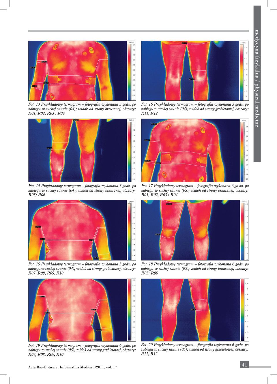 po zabiegu w suchej saunie (04); widok od strony grzbietowej, obszary: R11, R12 inżynieria medycyna fizykalna biomedyczna / physical / biomedical medicine engineering Fot.