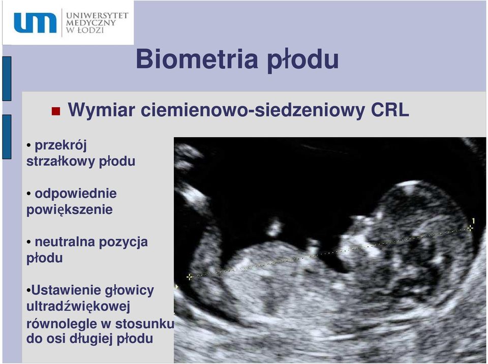 neutralna pozycja płodu Ustawienie głowicy