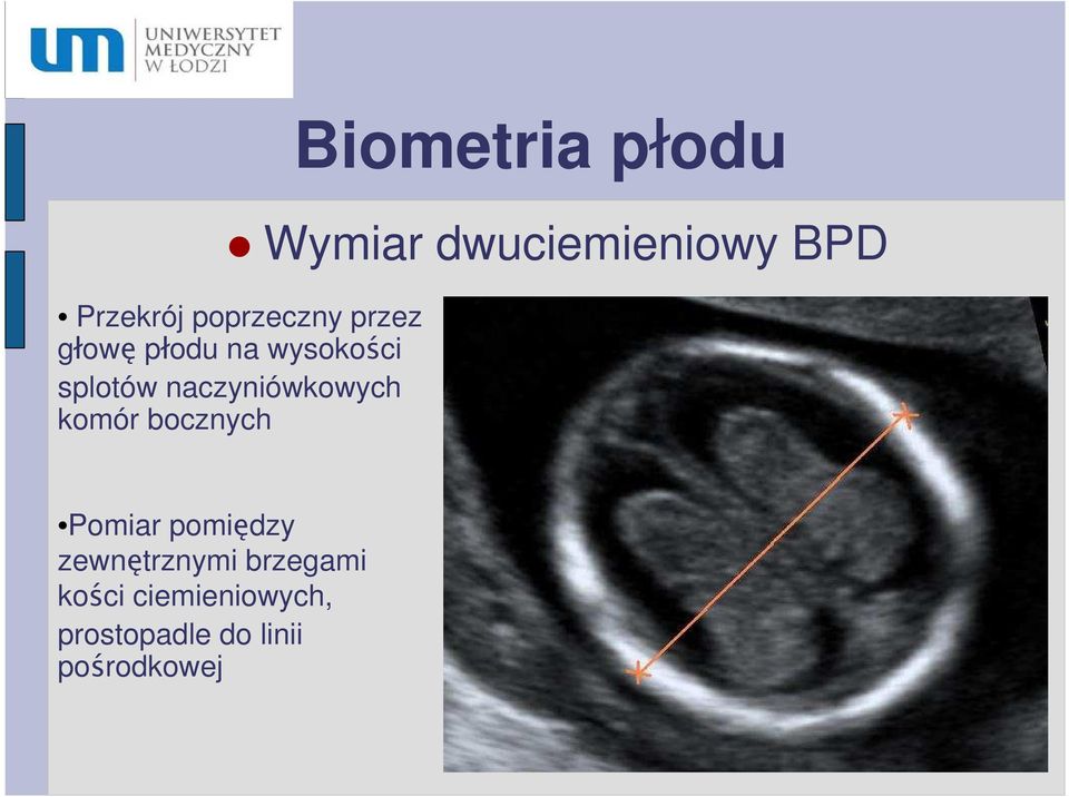 naczyniówkowych komór bocznych Pomiar pomiędzy