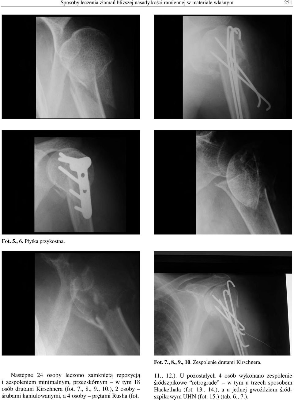 Następne 24 osoby leczono zamkniętą repozycją i zespoleniem minimalnym, przezskórnym w tym 18 osób drutami Kirschnera (fot. 7., 8., 9., 10.