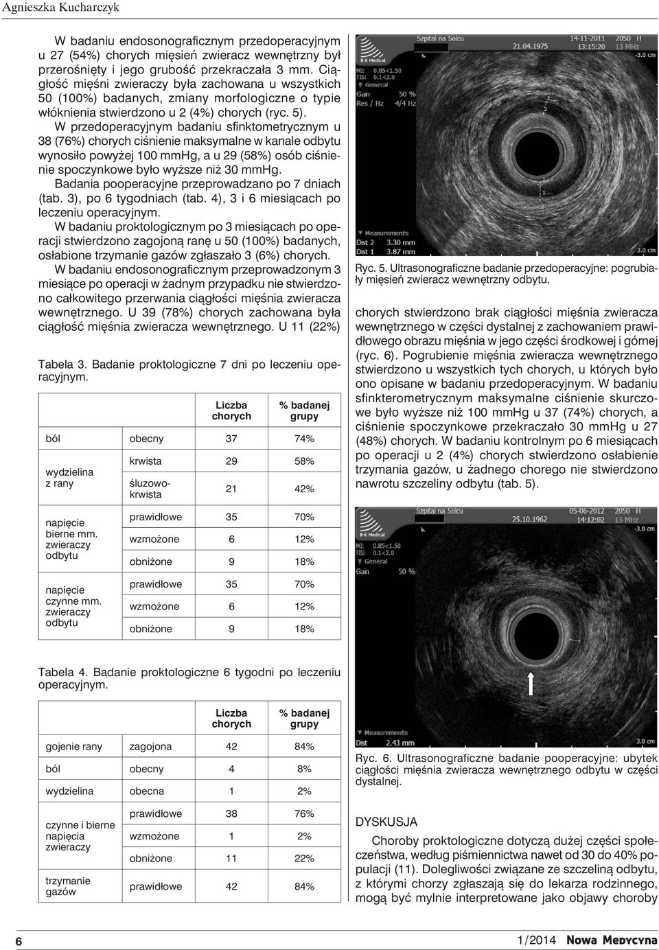 W przedoperacyjnym badaniu sfinktometrycznym u 38 (76%) ciśnienie maksymalne w kanale wynosiło powyżej 100 mmhg, a u 29 (58%) osób ciśnienie spoczynkowe było wyższe niż 30 mmhg.