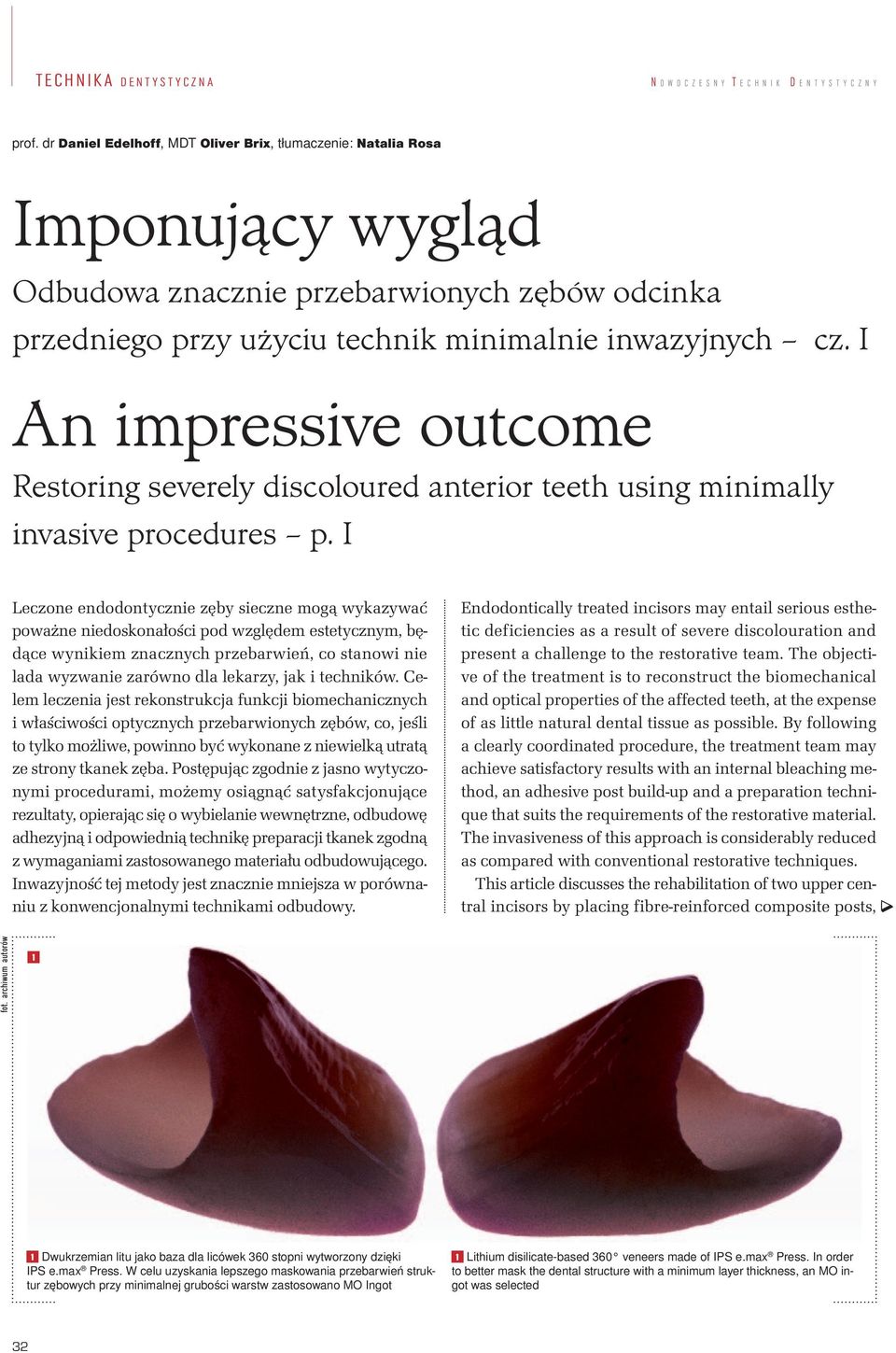 I Leczone endodontycznie zęby sieczne mogą wykazywać poważne niedoskonałości pod względem estetycznym, będące wynikiem znacznych przebarwień, co stanowi nie lada wyzwanie zarówno dla lekarzy, jak i