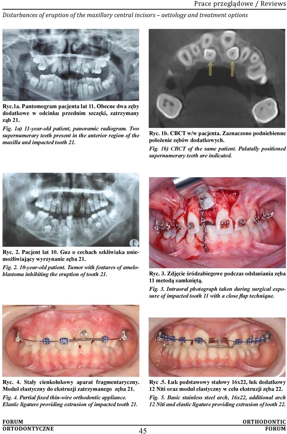 Zaznaczono podniebienne położenie zębów dodatkowych. Fig. 1b) CBCT of the same patient. Palatally positioned supernumerary teeth are indicated. Ryc. 2. Pacjent lat 10.