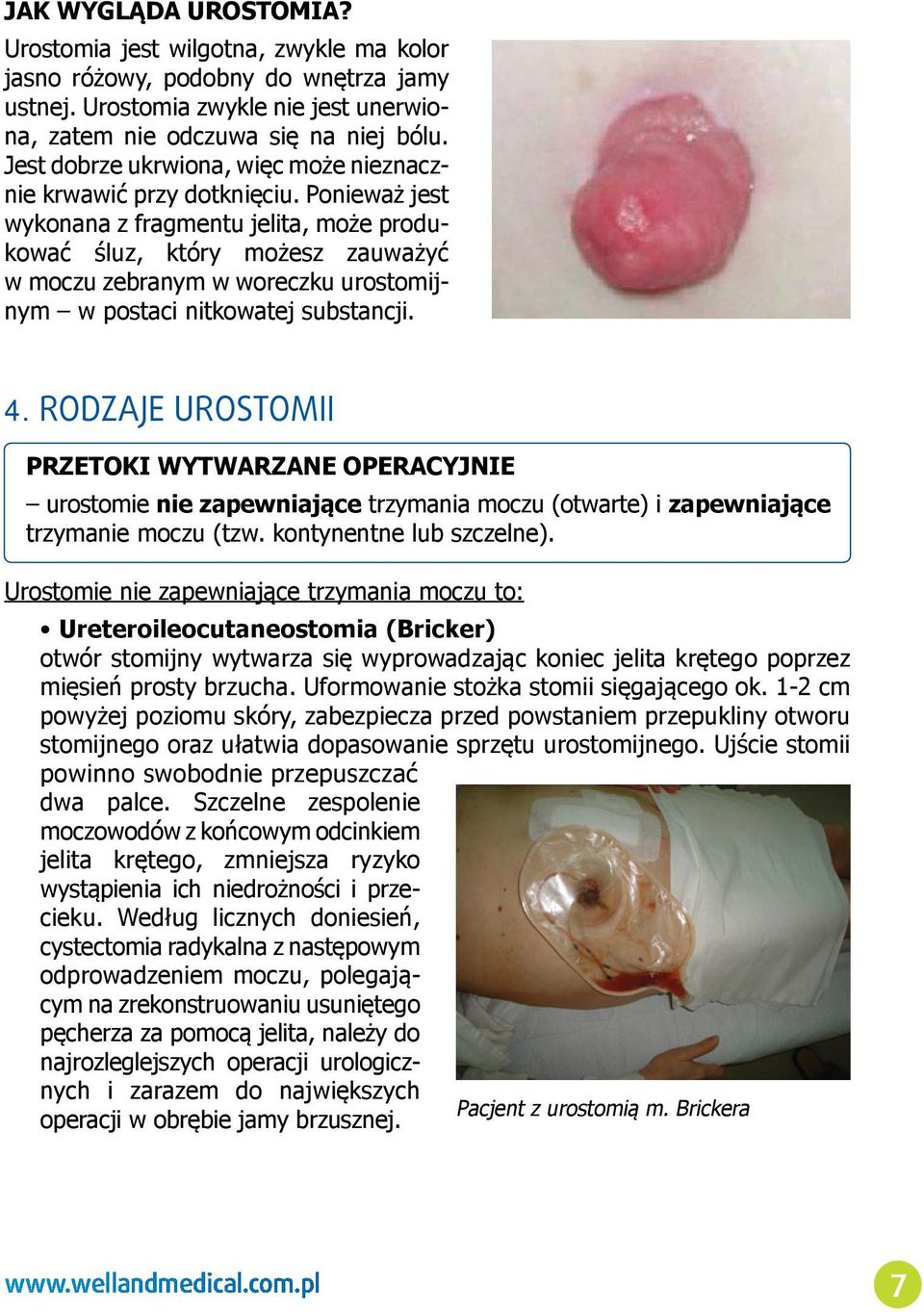 Ponieważ jest wykonana z fragmentu jelita, może produkować śluz, który możesz zauważyć w moczu zebranym w woreczku urostomijnym w postaci nitkowatej substancji. 4.