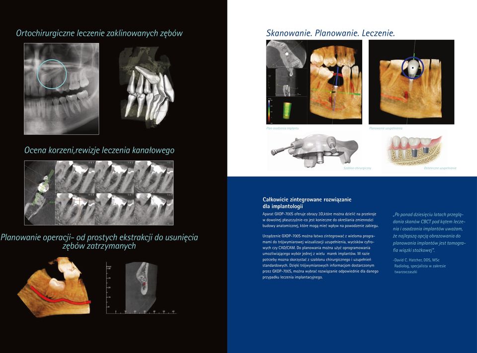 zatrzymanych Całkowicie zintegrowane rozwiązanie dla implantologii Aparat GXDP-700S oferuje obrazy 3D,które można dzielić na przekroje w dowolnej płaszczyźnie-co jest konieczne do określania