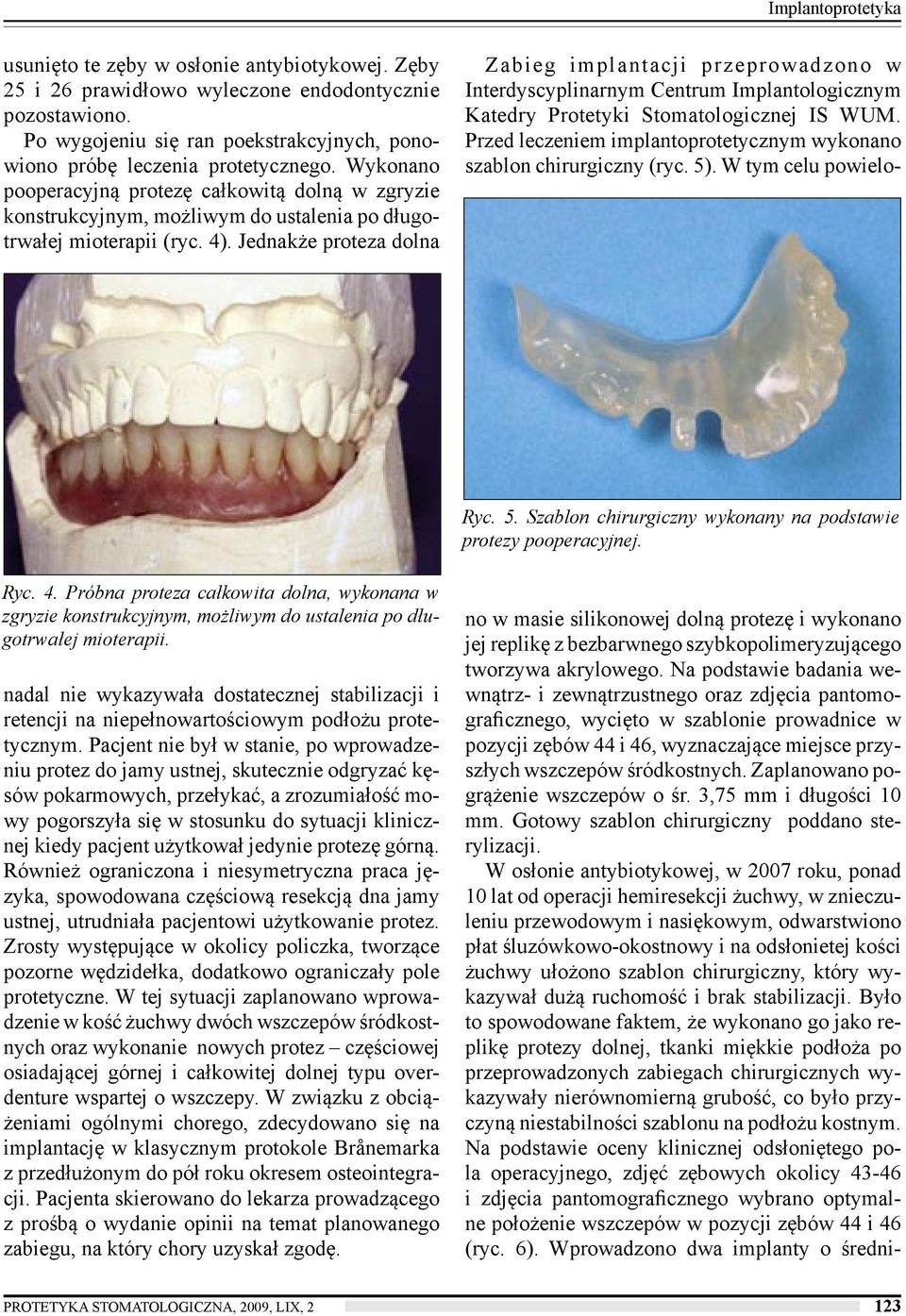 Wykonano pooperacyjną protezę całkowitą dolną w zgryzie konstrukcyjnym, możliwym do ustalenia po długotrwałej mioterapii (ryc. 4). Jednakże proteza dolna Ryc. 5.