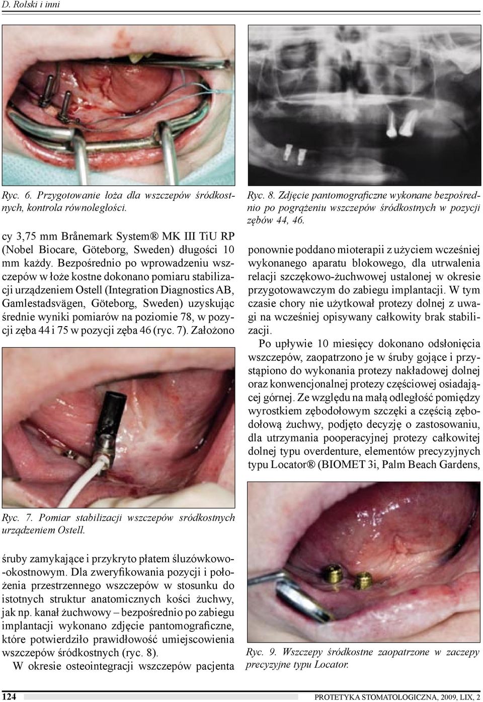 na poziomie 78, w pozycji zęba 44 i 75 w pozycji zęba 46 (ryc. 7). Założono Ryc. 8. Zdjęcie pantomograficzne wykonane bezpośrednio po pogrążeniu wszczepów śródkostnych w pozycji zębów 44, 46.