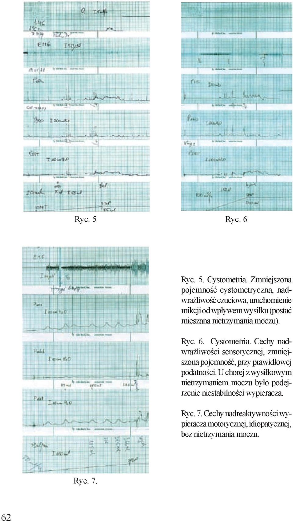 nietrzymania moczu). Ryc. 6. Cystometria.