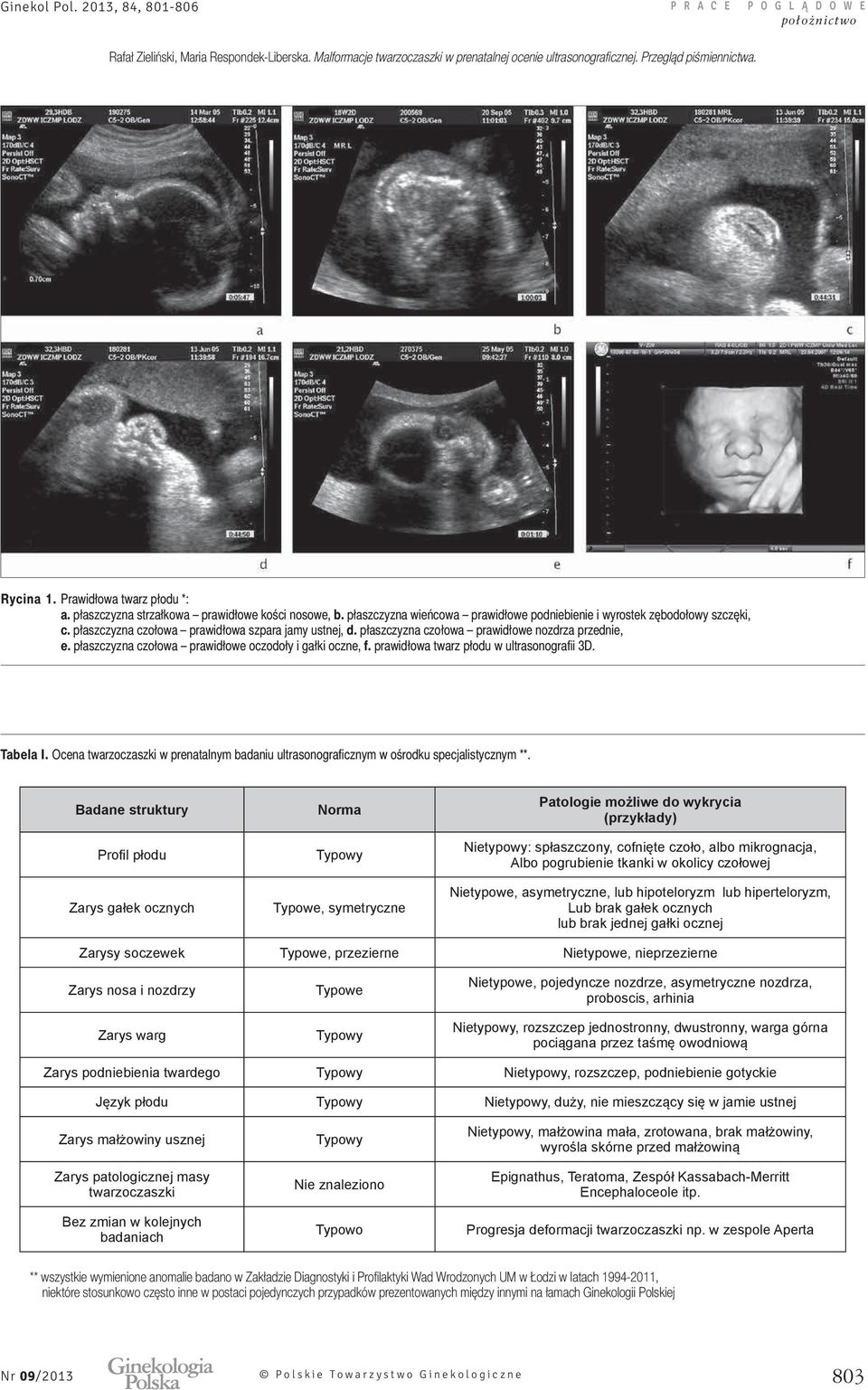 prawidłowa twarz płodu w ultrasonografii 3D. Tabela I. Ocena twarzoczaszki w prenatalnym badaniu ultrasonograficznym w ośrodku specjalistycznym **.
