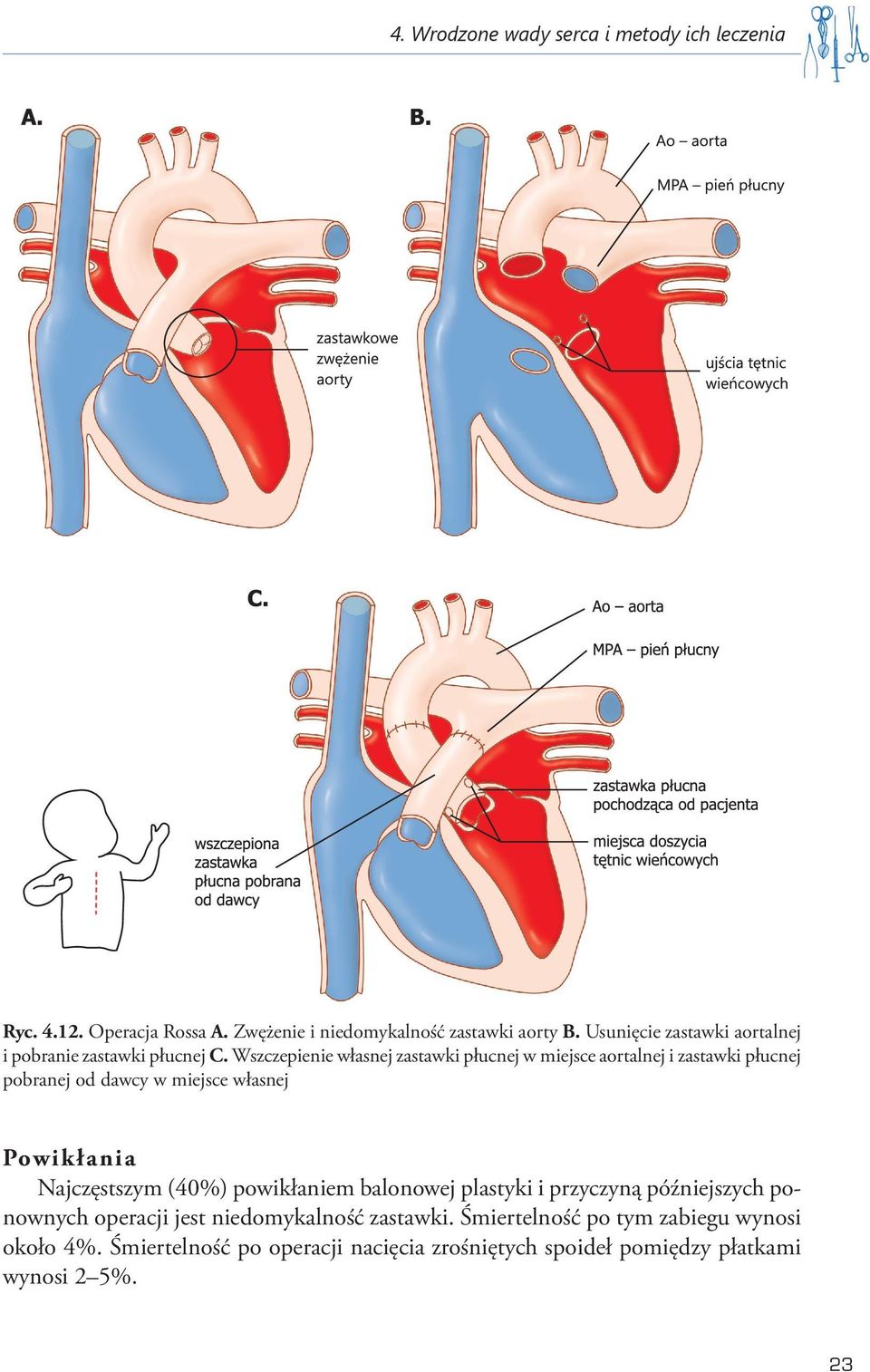 Wszczepienie własnej zastawki płucnej w miejsce aortalnej i zastawki płucnej pobranej od dawcy w miejsce własnej Pow ikłan ia Najczęstszym