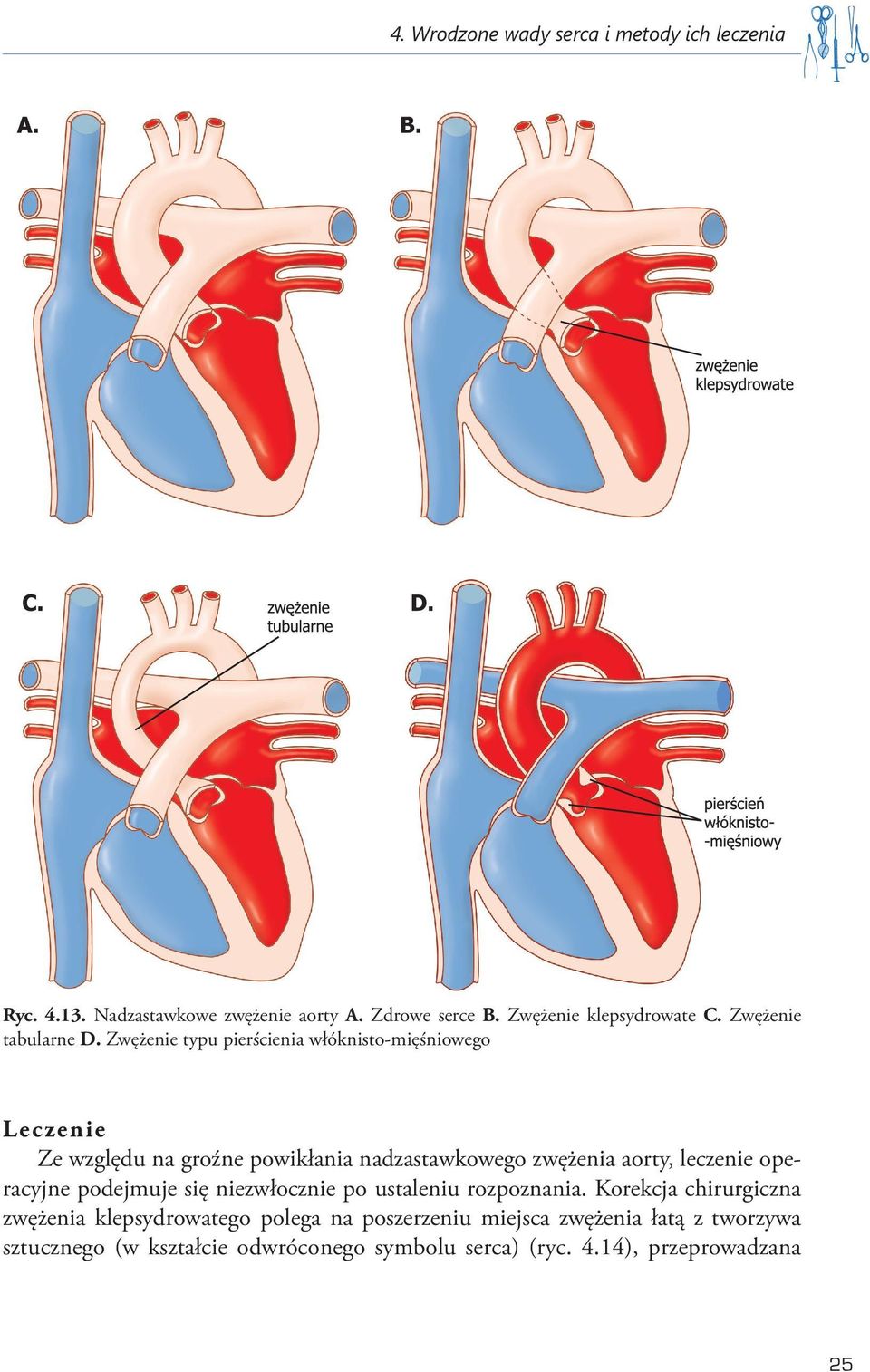 Zwężenie typu pierścienia włóknisto-mięśniowego Lec zen ie Ze względu na groźne powikłania nadzastawkowego zwężenia aorty, leczenie
