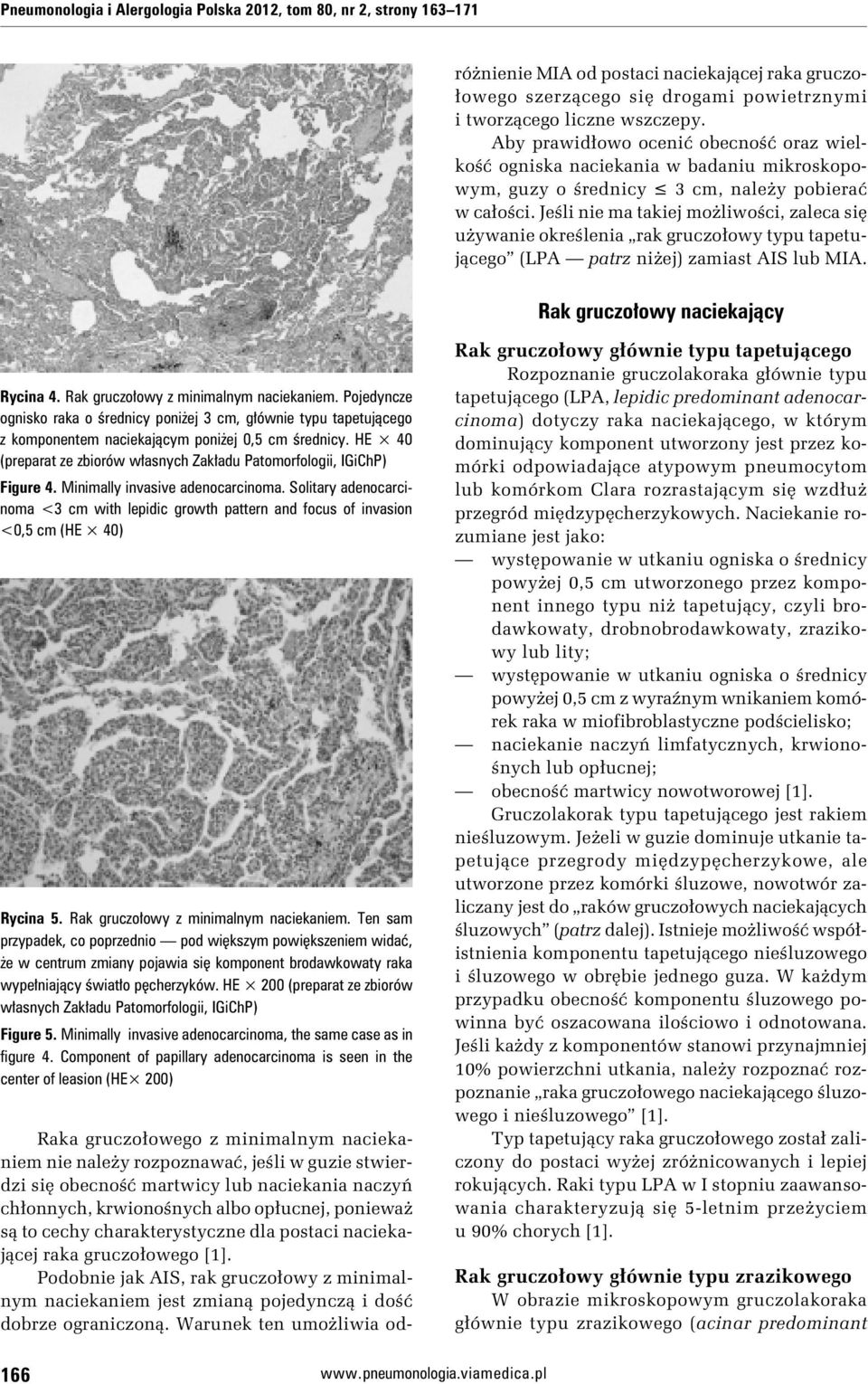 Podobnie jak AIS, rak gruczołowy z minimalnym naciekaniem jest zmianą pojedynczą i dość dobrze ograniczoną.