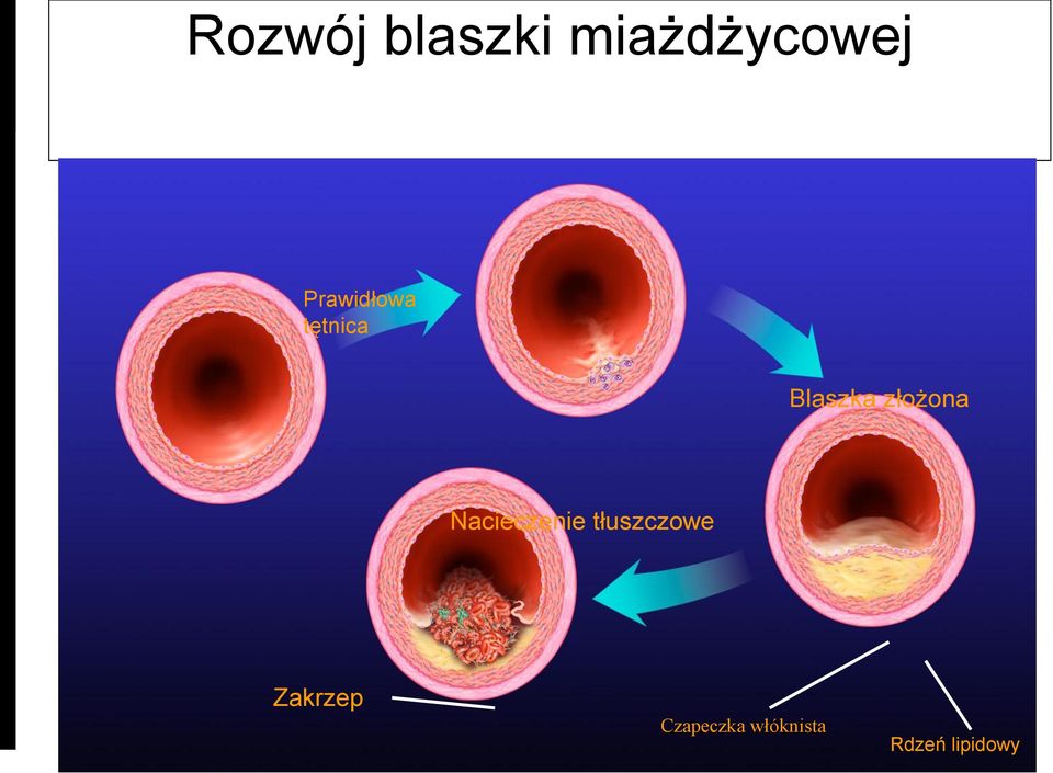 złożona Nacieczenie tłuszczowe