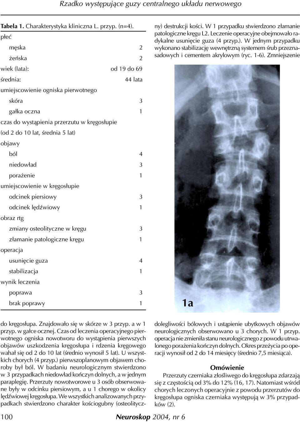 objawy ból 4 niedow³ad 3 pora enie 1 umiejscowienie w krêgos³upie odcinek piersiowy 3 odcinek lêdÿwiowy 1 obraz rtg zmiany osteolityczne w krêgu 3 z³amanie patologiczne krêgu 1 operacja usuniêcie