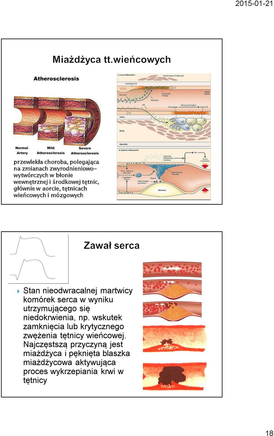 wyniku utrzymującego się niedokrwienia, np. wskutek zamknięcia lub krytycznego zwężenia tętnicy wieńcowej.