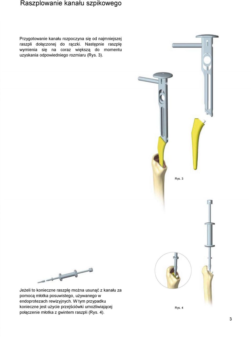 3 Jeżeli to konieczne raszplę można usunąć z kanału za pomocą młotka posuwistego, używanego w endoprotezach