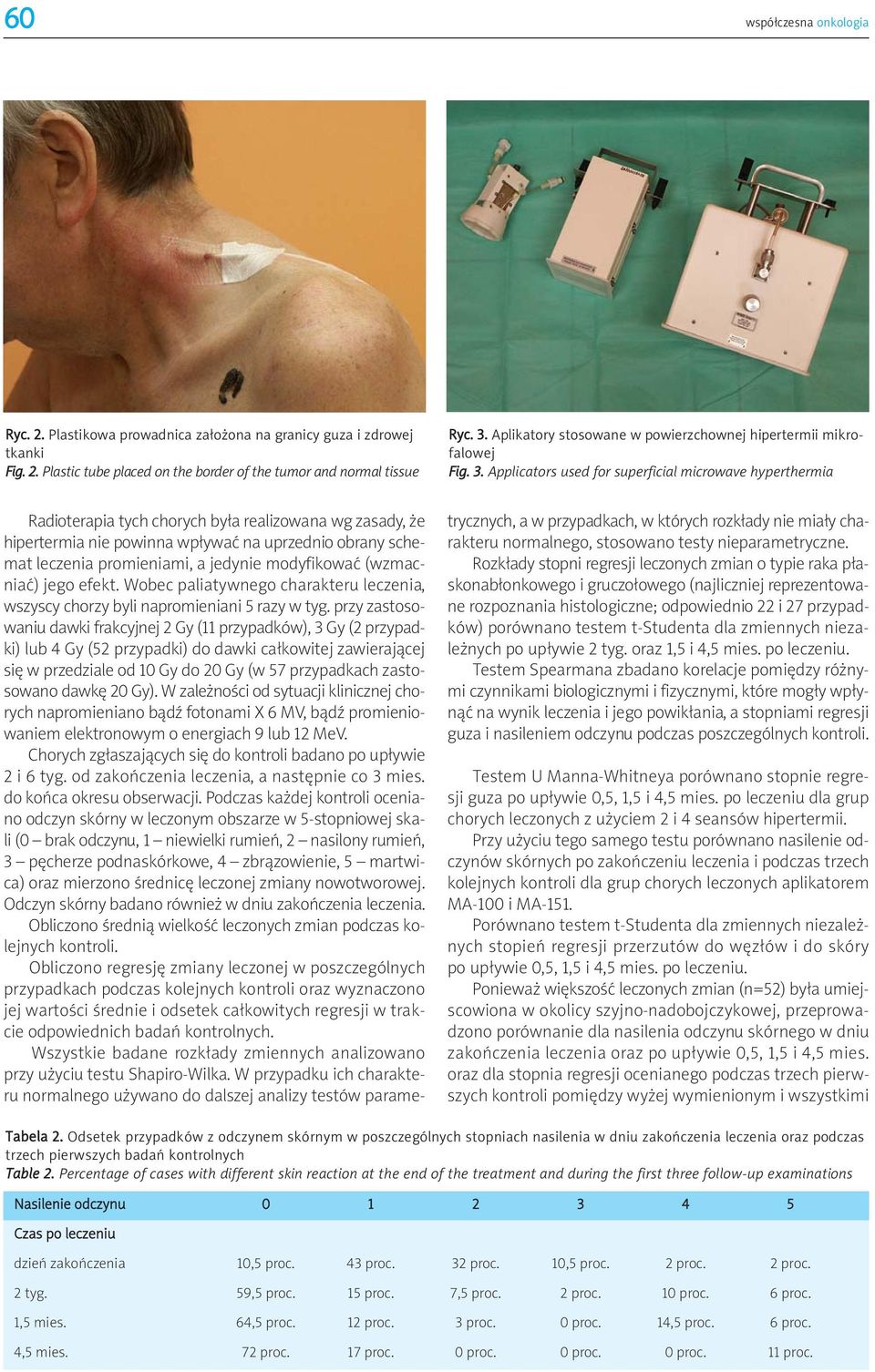 Applicators used for superficial microwave hyperthermia Radioterapia tych chorych była realizowana wg zasady, że hipertermia nie powinna wpływać na uprzednio obrany schemat leczenia promieniami, a