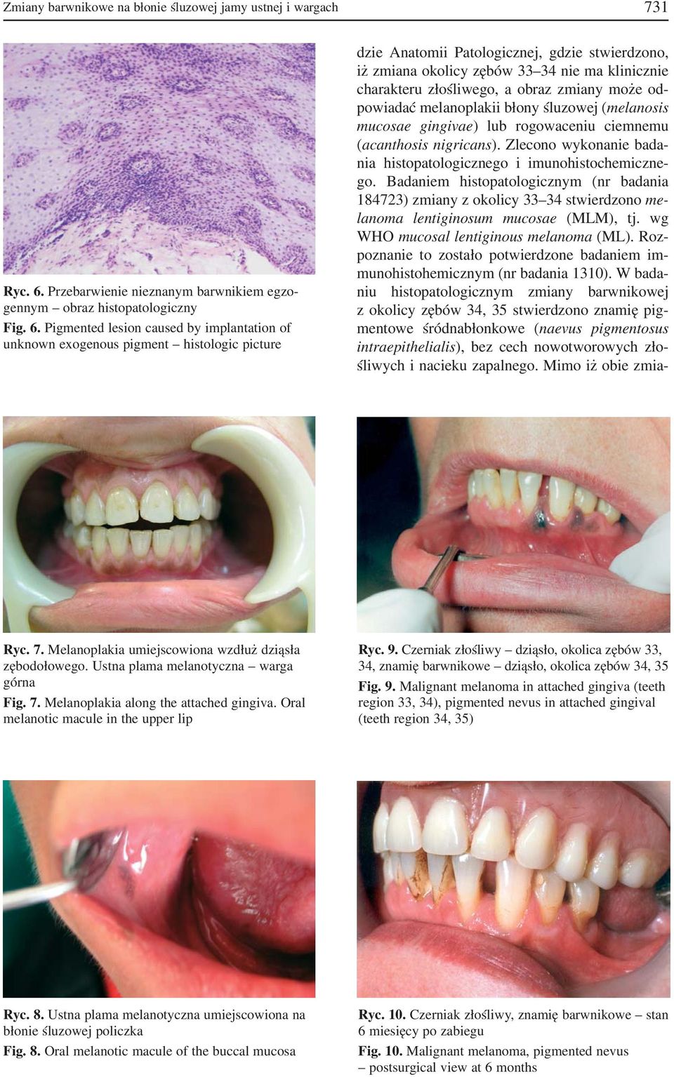 Pigmented lesion caused by implantation of unknown exogenous pigment histologic picture dzie Anatomii Patologicznej, gdzie stwierdzono, iż zmiana okolicy zębów 33 34 nie ma klinicznie charakteru