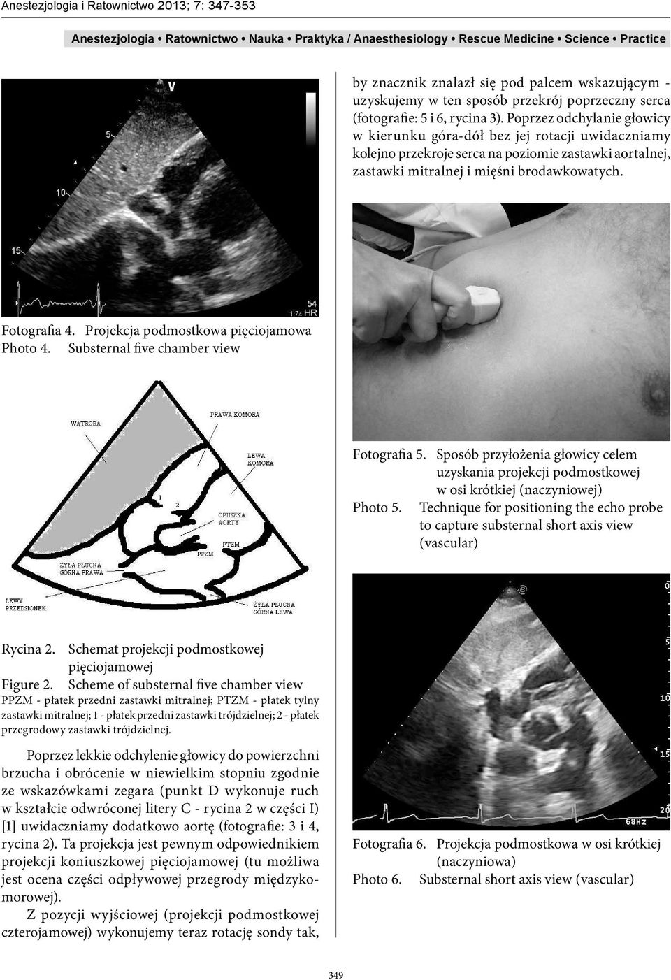 Projekcja podmostkowa pięciojamowa Photo 4. Substernal five chamber view Fotografia 5. Sposób przyłożenia głowicy celem uzyskania projekcji podmostkowej w osi krótkiej (naczyniowej) Photo 5.