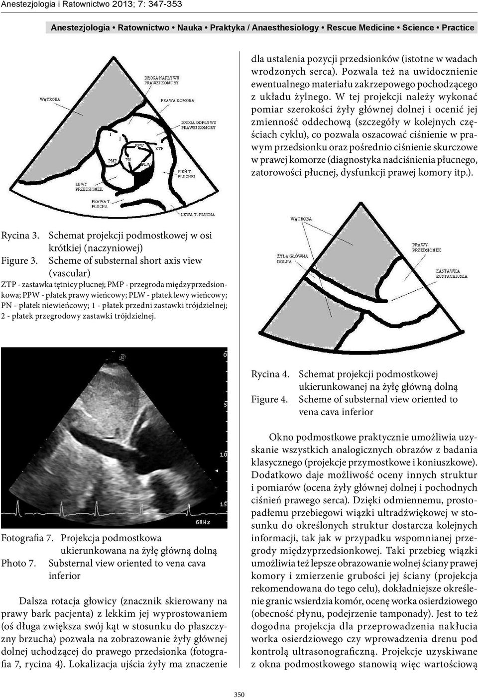 pośrednio ciśnienie skurczowe w prawej komorze (diagnostyka nadciśnienia płucnego, zatorowości płucnej, dysfunkcji prawej komory itp.). Rycina 3.