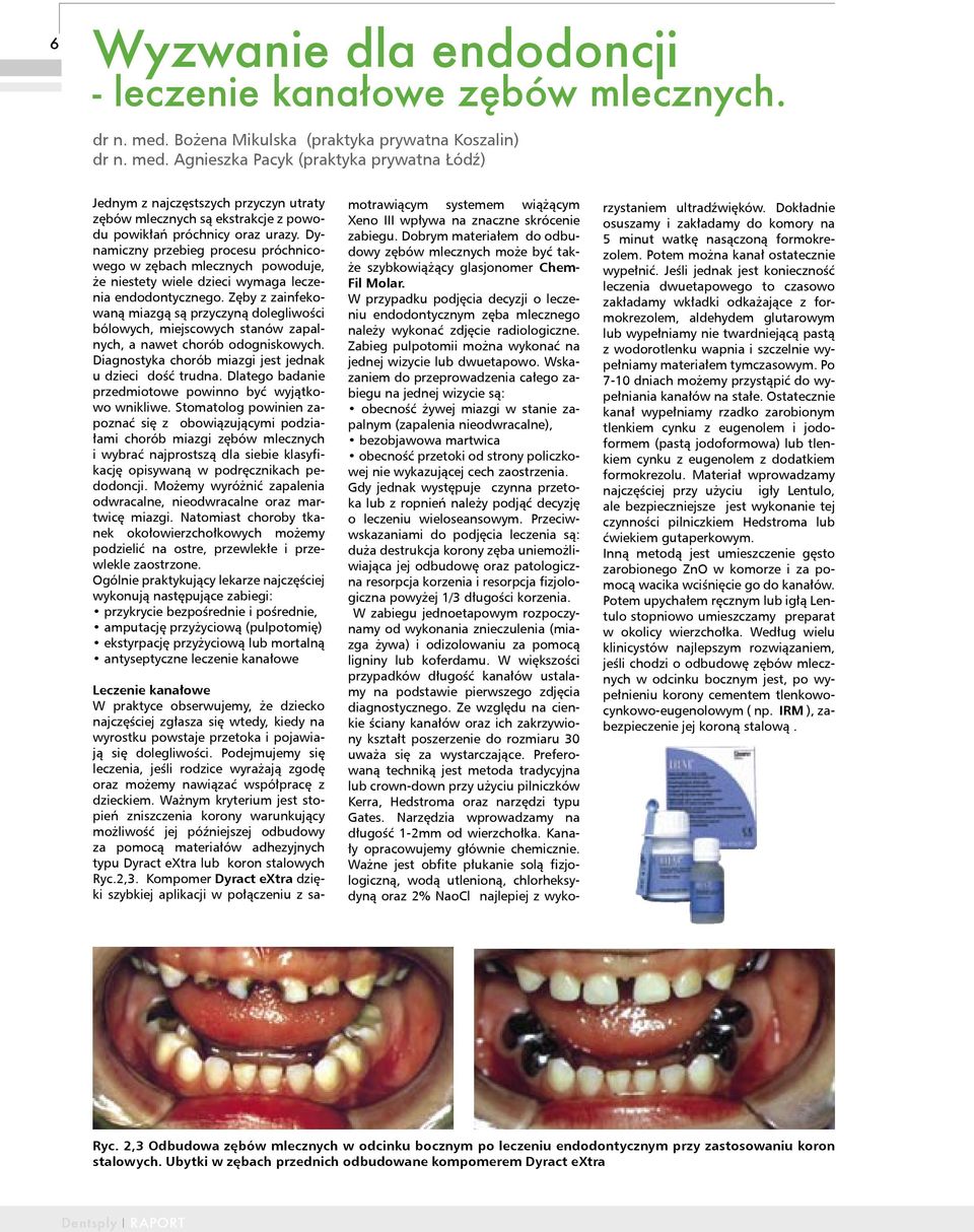 Agnieszka Pacyk (praktyka prywatna Łódź) Jednym z najczęstszych przyczyn utraty zębów mlecznych są ekstrakcje z powodu powikłań próchnicy oraz urazy.