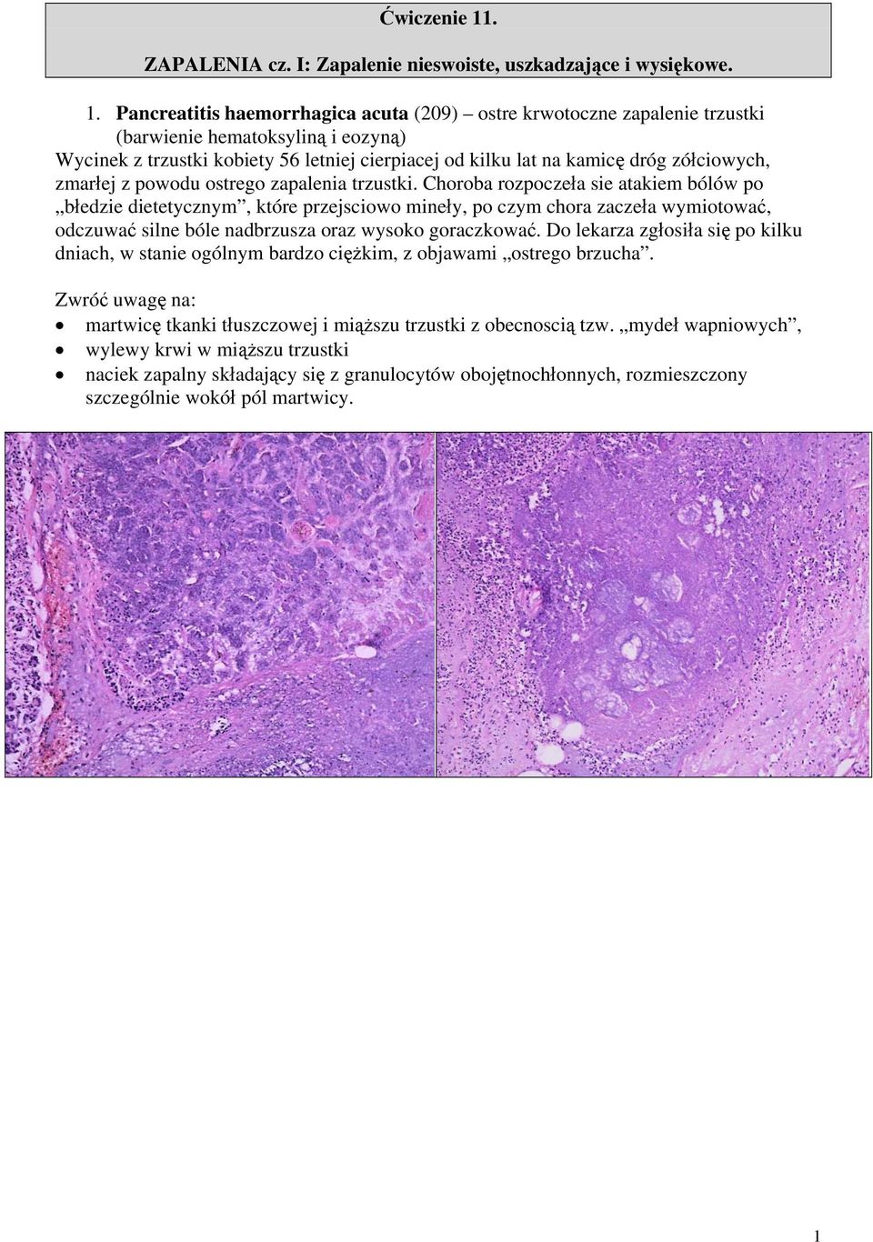 Pancreatitis haemorrhagica acuta (209) ostre krwotoczne zapalenie trzustki (barwienie hematoksyliną i eozyną) Wycinek z trzustki kobiety 56 letniej cierpiacej od kilku lat na kamicę dróg zółciowych,