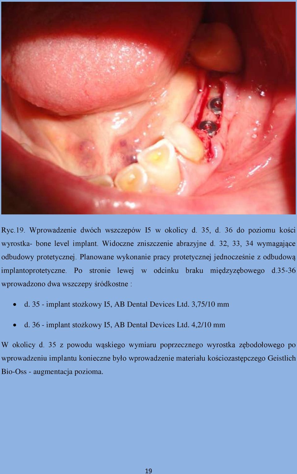 Po stronie lewej w odcinku braku międzyzębowego d.35-36 wprowadzono dwa wszczepy śródkostne : d. 35 - implant stożkowy I5, AB Dental Devices Ltd. 3,75/10 mm d.