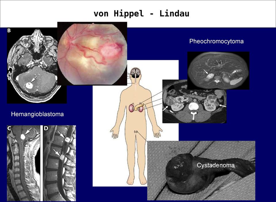 Pheochromocytoma