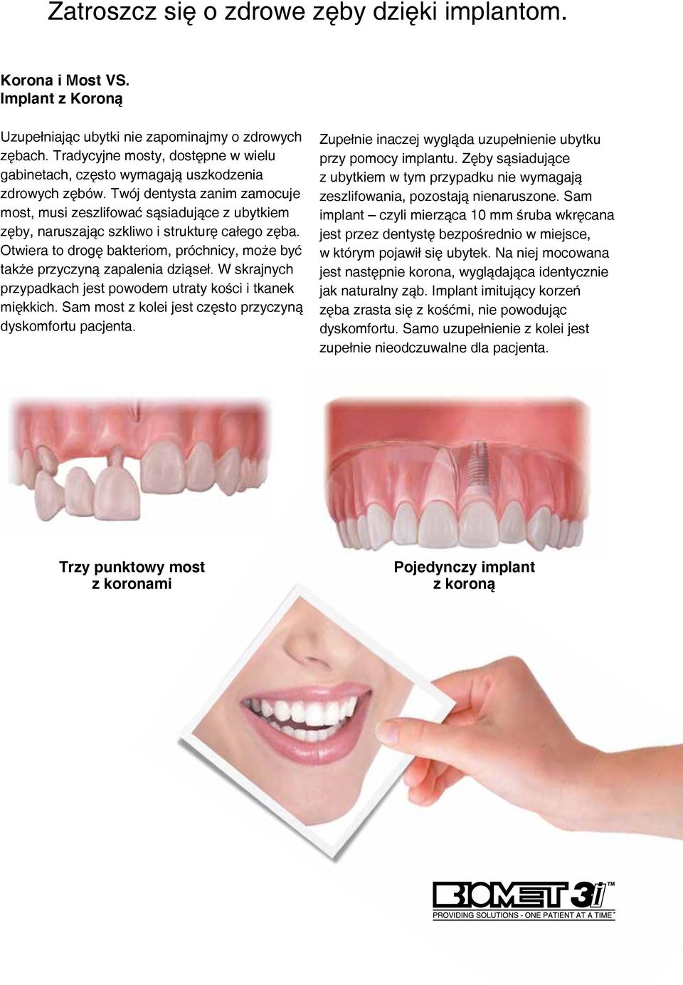 Twój dentysta zanim zamocuje most, musi zeszlifować sąsiadujące z ubytkiem zęby, naruszając szkliwo i strukturę całego zęba.