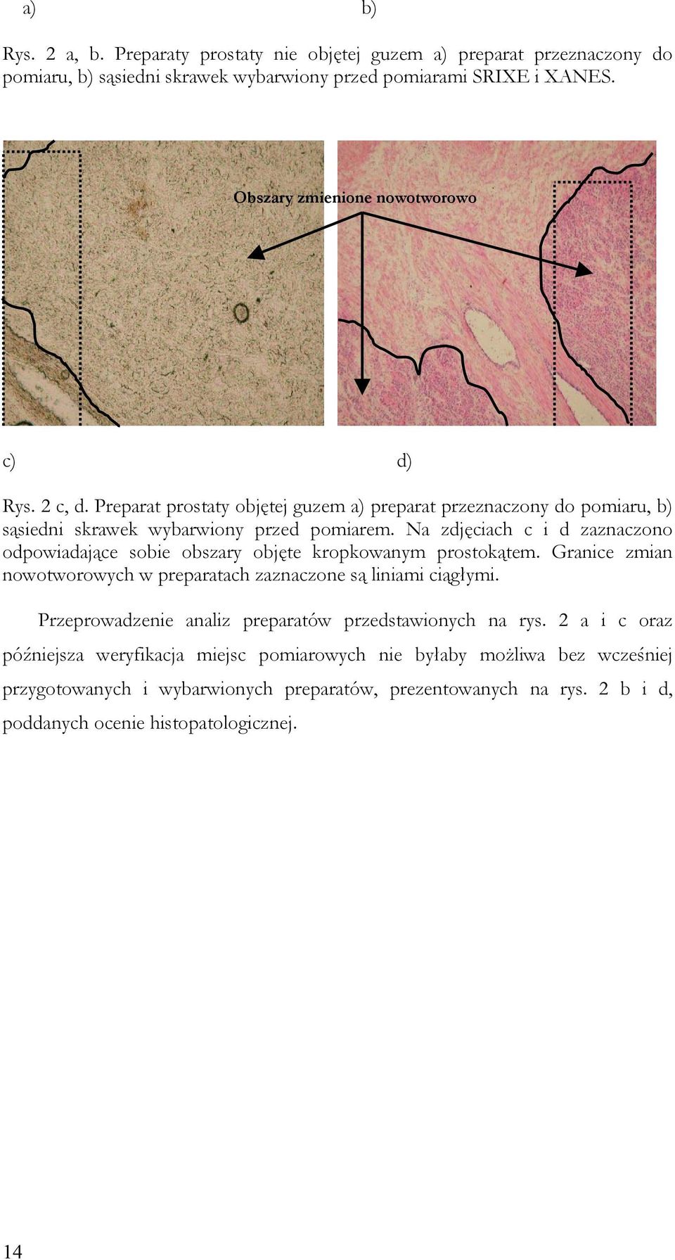 Na zdjęciach c i d zaznaczono odpowiadające sobie obszary objęte kropkowanym prostokątem. Granice zmian nowotworowych w preparatach zaznaczone są liniami ciągłymi.