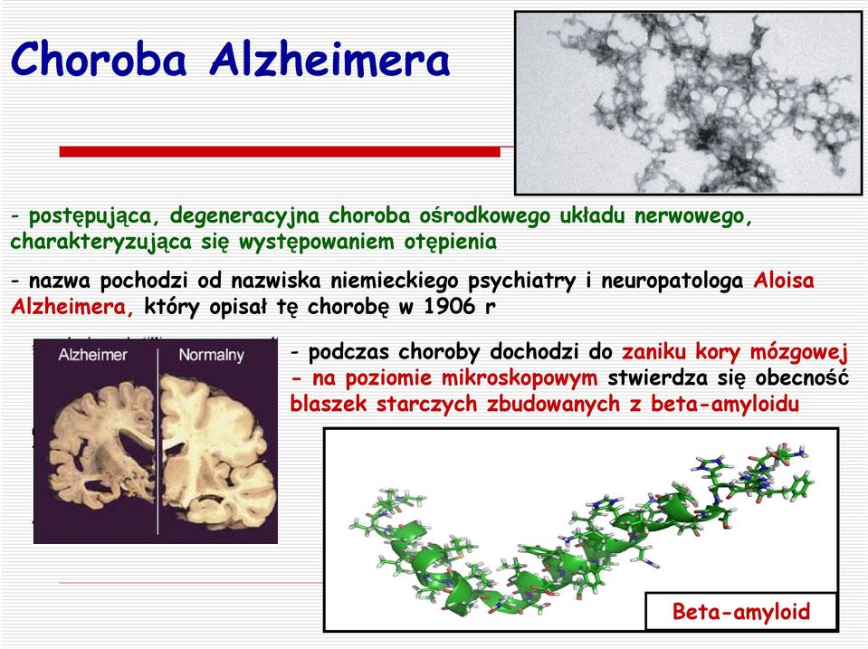 lzheimera, który opisał tę chorobę w 1906 r - podczas choroby dochodzi do zaniku kory mózgowej - na