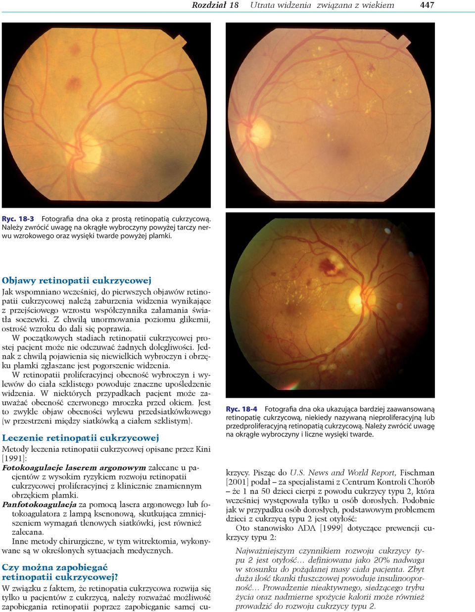 Objawy retinopatii cukrzycowej Jak wspomniano wcześniej, do pierwszych objawów retinopatii cukrzycowej należą zaburzenia widzenia wynikające z przejściowego wzrostu współczynnika załamania światła