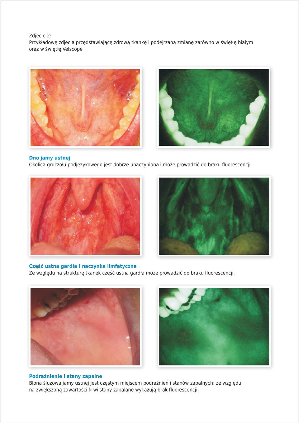 Czêœæ ustna gard³a i naczynka limfatyczne Ze wzglêdu na strukturê tkanek czêœæ ustna gard³a mo e prowadziæ do braku fluorescencji.
