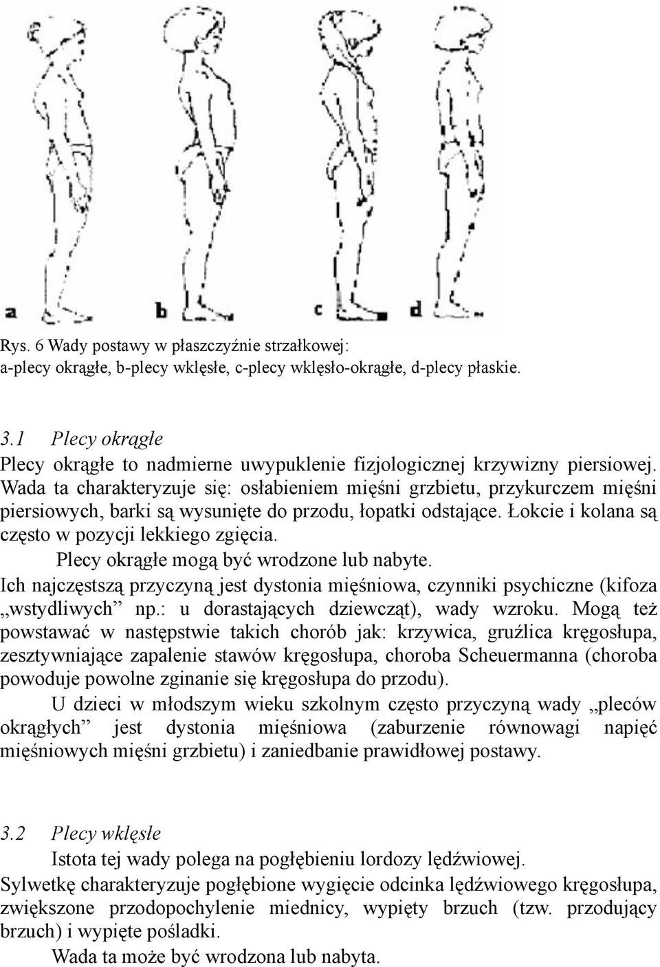 Wada ta charakteryzuje się: osłabieniem mięśni grzbietu, przykurczem mięśni piersiowych, barki są wysunięte do przodu, łopatki odstające. Łokcie i kolana są często w pozycji lekkiego zgięcia.