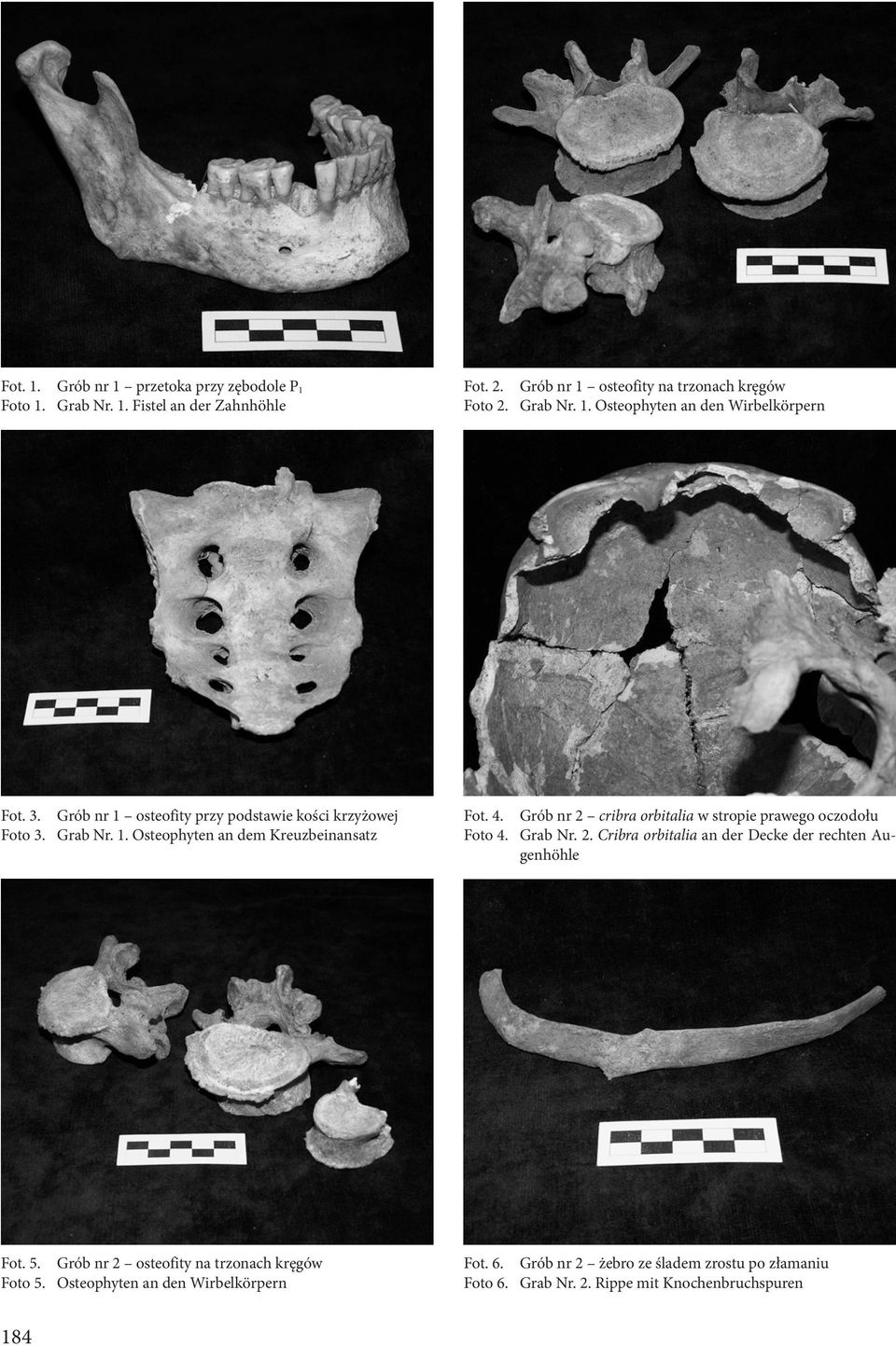 Grób nr 2 cribra orbitalia w stropie prawego oczodołu Foto 4. Grab Nr. 2. Cribra orbitalia an der Decke der rechten Augenhöhle Fot. 5.