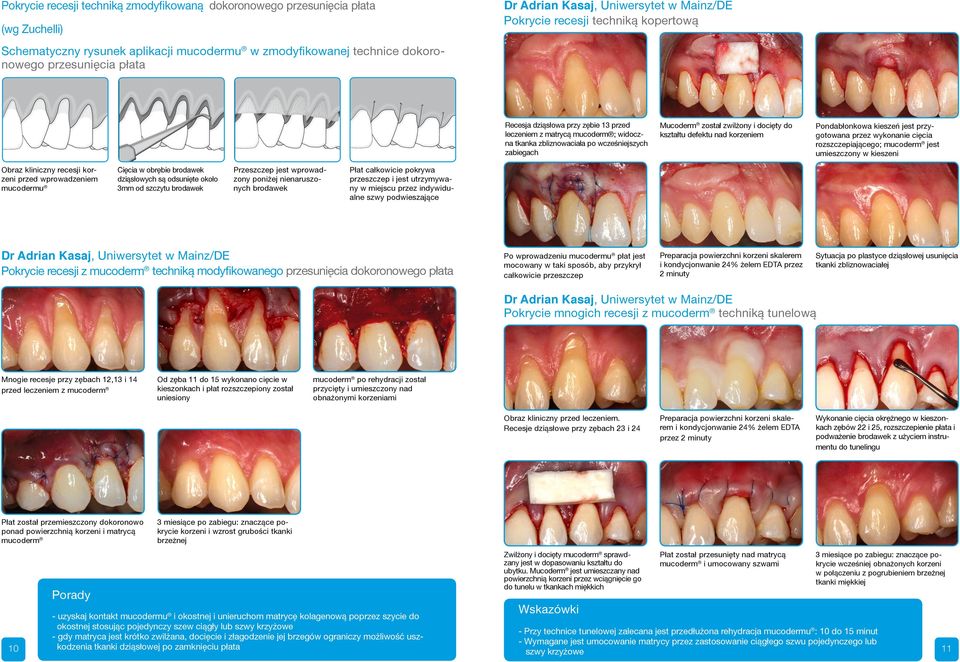 wprowadzony poniżej nienaruszonych brodawek Recesja dziąsłowa przy zębie 13 przed leczeniem z matrycą mucoderm ; widoczna tkanka zbliznowaciała po wcześniejszych zabiegach Mucoderm został zwilżony i