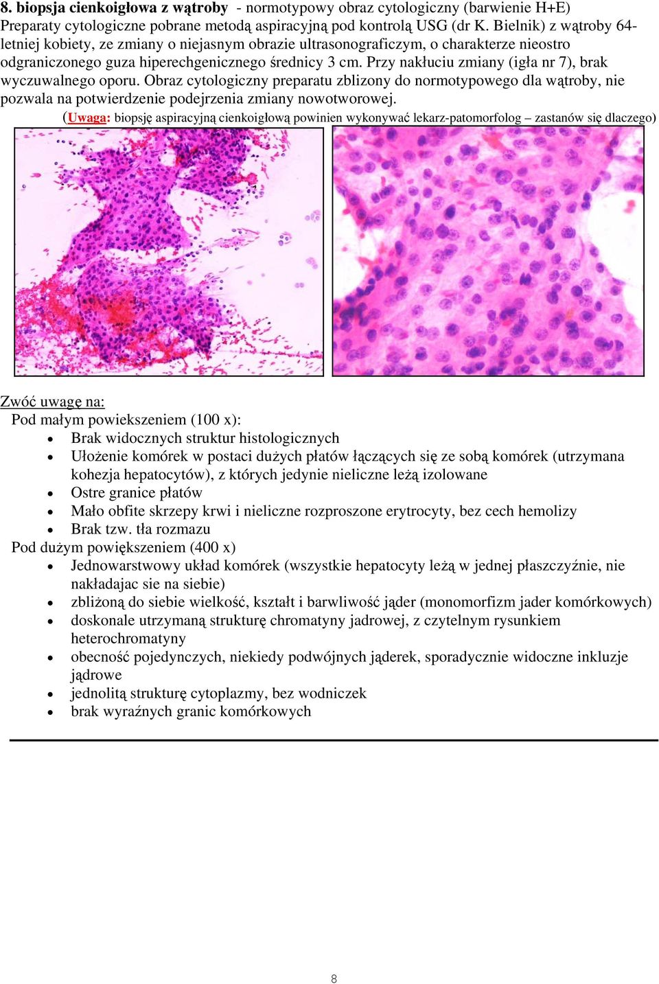 Przy nakłuciu zmiany (igła nr 7), brak wyczuwalnego oporu. Obraz cytologiczny preparatu zblizony do normotypowego dla wątroby, nie pozwala na potwierdzenie podejrzenia zmiany nowotworowej.