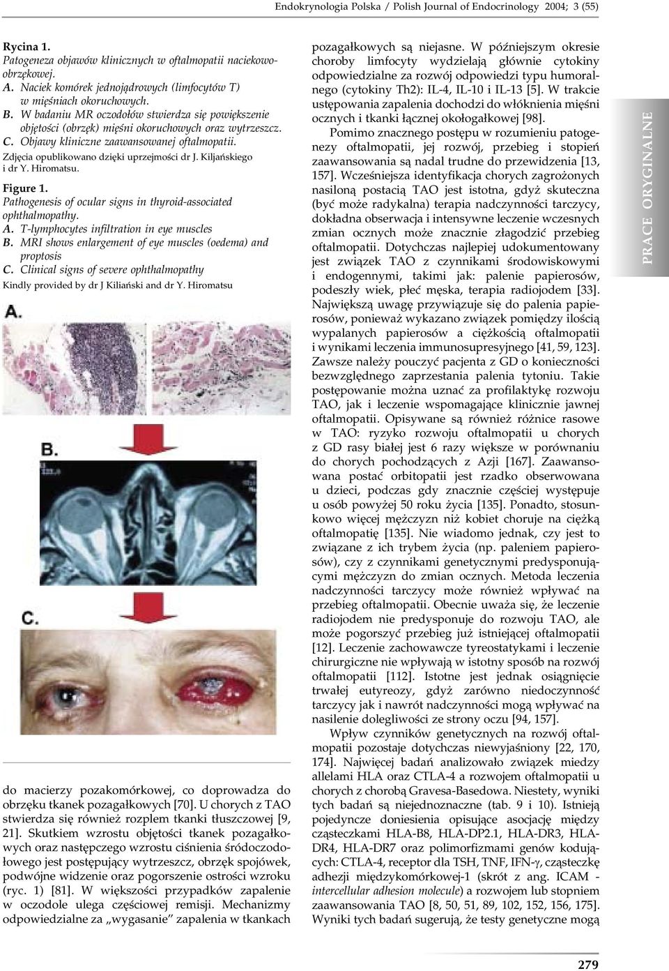 Objawy kliniczne zaawansowanej oftalmopatii. Zdjęcia opublikowano dzięki uprzejmości dr J. Kiljańskiego i dr Y. Hiromatsu. Figure 1. Pathogenesis of ocular signs in thyroid-associated ophthalmopathy.