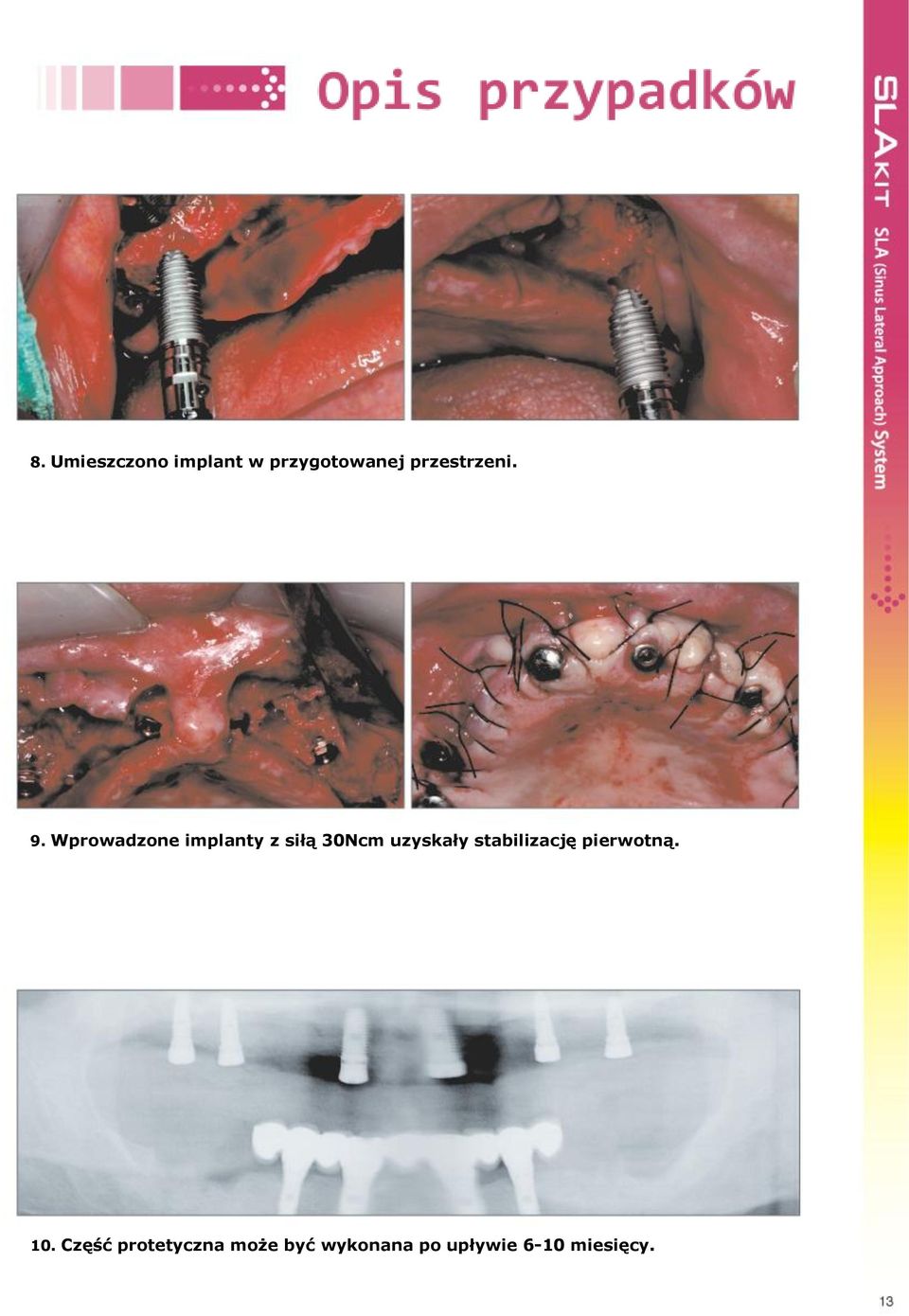 Wprowadzone implanty z siłą 30Ncm uzyskały stabilizację pierwotną. 10.
