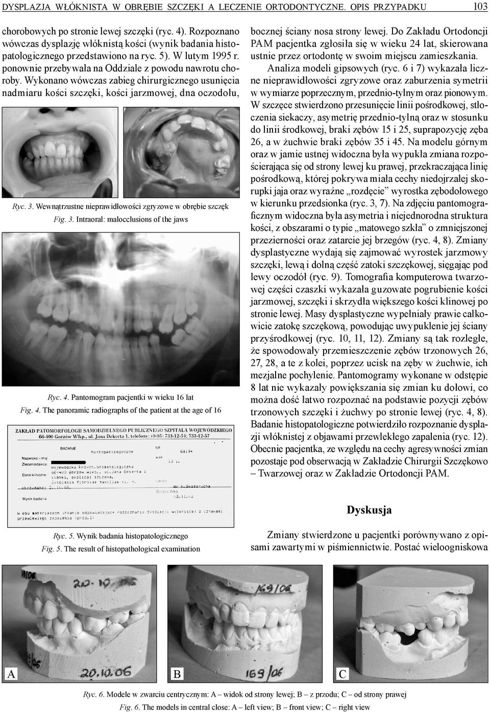 Wykonano wówczas zabieg chirurgicznego usunięcia nadmiaru kości szczęki, kości jarzmowej, dna oczodołu, Ryc. 3. Wewnątrzustne nieprawidłowości zgryzowe w obrębie szczęk Fig. 3. Intraoral: malocclusions of the jaws Ryc.