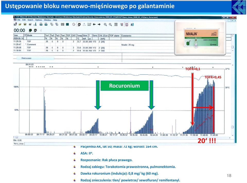 Rozpoznanie: Rak płuca prawego. Rodzaj zabiegu: Torakotomia prawostronna, pulmonektomia.